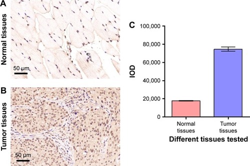 Figure 7 GPC-1 is increased in the tumor tissues of COLO-357 tumor-bearing nude mice. (A, B) IHC staining of GPC-1 (brown color) in the normal tissues (A) and COLO-357 tumor tissues (B). (C) IOD of the results of (A, B).Abbreviations: GPC-1, Glypican-1; IHC, immunohistochemical; IOD, integrated optical density.