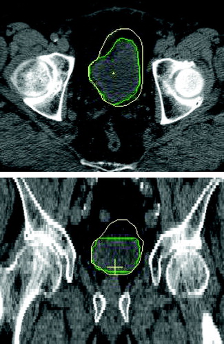 Figure 3.  Transverse (upper) and coronal (lower) views of the bladder shape variation for one patient. The green contour is the planning CTV while the yellow contour is a repeat CTV translated to the (patient) right tumour position.