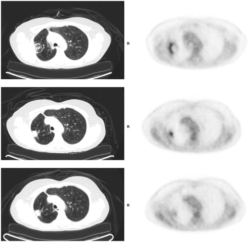 Figure 2. FDG PET pitfall. (Top) FDG PET/CT 1 month post-radiofrequency ablation with electrodes shows expected ring of intense uptake along periphery of treated right upper lobe cancer and inflammatory soft tissue by CT. (Middle) FDG PET/CT 6 months post-RFA showed focal intense uptake centrally within the treatment zone that is modestly higher in magnitude compared to immediate prior PET. There is contracting soft tissue by CT. (Bottom) FDG 13 months post-RFA shows non-focal moderate uptake (similar to mediastinal background) at treatment site. Soft tissue at treatment site is stable by CT.
