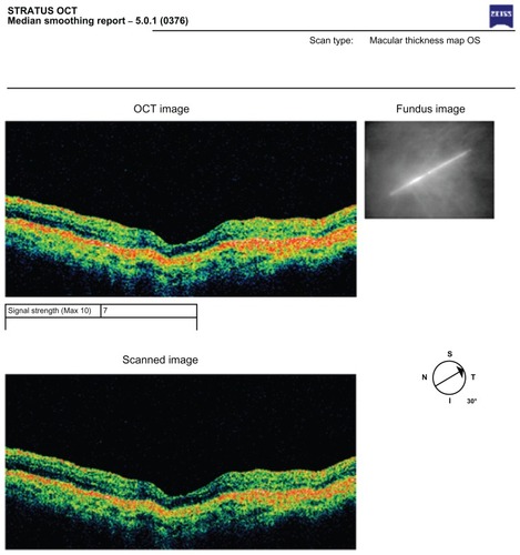 Figure 5 OCT image – inactive ARMD.