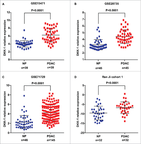 Figure 1. DKK-1 expression in PDAC tissue at mRNA level. (A-C). Expression of DKK-1 was significantly increased in PDAC tumor tissues compared with the adjacent non-tumor tissues (ANT) in GSE 15471, GSE 28735 and GSE 71729. (D) The result of qRT-PCR in Ren Ji cohort 1 showed that the expression of DKK-1 was elevated in PDAC tissue compared with normal pancreas (NP).