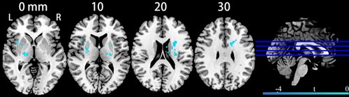 Figure 1 Clusters showing brain entropy differences in MDD patients compared with HC. Significance level was defined at voxel p < 0.005, cluster p < 0.05, GRF corrected. L refers to the left side of the images in the coronal, and horizontal sections correspond to the left side of the brain.