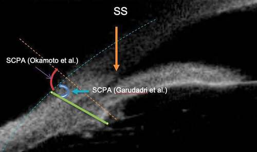 Figure 5. Figure depicting scleral ciliary process angle (SCPA) as described by Okamoto et al.Citation8 and Garudadri et al.Citation3 SS: scleral spur.