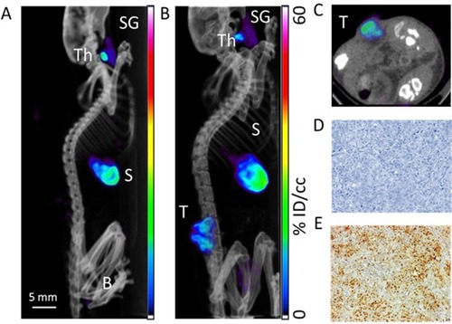 Figure 5 Assessment of radioiodine uptake by the NIS-expressing xenografts using microSPECT-CT imaging. (A) Radiotracer uptake was observed in tissues which express endogenous NIS in a control Balb/c female athymic mouse injected with an intraperitoneal administration of 15 MBq 99mTcO4- and imaged with a microSPECT-CT camera (eXplore speCZT, General Electric): thyroid (Th), salivary glands (SG), stomach (S), and urinary bladder (B). Representative SPECT/CT sagittal (B) and transverse (C) sections of three-dimensional images of a B16-NIS-bearing mouse 10 days after subcutaneous injection of the tumour cells. (T) B16-NIS tumor. (D) Hematoxylin-stained sections of B16-NIS tumors show highly proliferating cells. (E) Representative NIS staining of tumor sections shows heterogeneity in NIS expression levels within lesions.