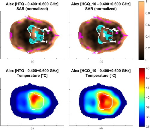 Figure 9. Treatment plans at 400 + 600 MHz for Alex. The SAR is normalized to the highest value in the patient. Transverse sections at target center. The target is delineated in white. The magenta/cyan voxels represent locations of highest/lowest SAR (hot-spot/cold-spot), excluding the first centimeter of tissue from the skin surface.