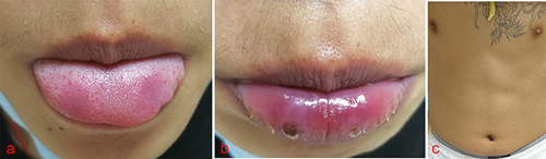 Figure 2 (a) The erosion surfaces of the patient’s lips became softer, smaller and flatter obviously. (b) The erosion surfaces of the patient’s tongue became softer, smaller and flatter obviously. (c) The erythema of the trunk completely subsided.