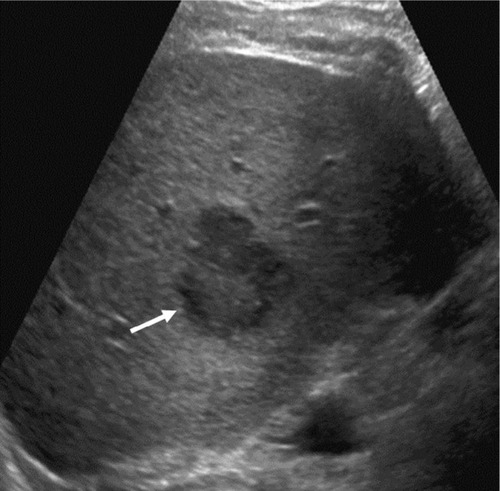 Figure 4 US LI-RADS Category 3 observation in a 59-year-old male with hepatitis C cirrhosis undergoing US surveillance.