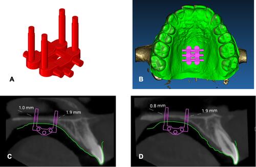 Figure 3 Positioning of MSE virtual model (A) on the integrated model of patient CBCT and digital model of maxillary dental arch. (B) Occlusal view. (C) Measurement of bone thickness at the level of left miniscrews. (D) Measurement of bone thickness at the level of right miniscrews. (A) is reproduced with permission from Dove Medical Press. Cantarella D, Savio G, Grigolato L, et al. A new methodology for the digital planning of micro-implant-supported maxillary skeletal expansion. Med Devices Evid Res. 2020;13:93–106.Citation19