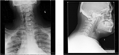 Figure 2. General diagnostic anterior-posterior and lateral views of the soft tissue neck. No radiographic evidence of food impaction. Slight deviation of trachea likely from rotation. Patent airway. Normal soft tissue structures. Mild ossification of stylohyoid ligament