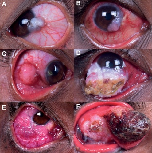 Figure 1 Clinical presentation of ocular surface squamous neoplasia in human immunodeficiency virus-infected patients.