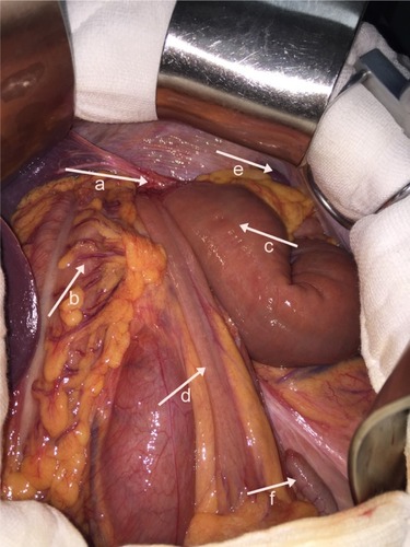 Figure 3 At exploratory laparotomy, the partial transverse colon with the total small bowel had herniated through the left esophageal hiatus into the left pleural cavity. a, esophageal hiatus; b, colon ascendens; c, proximal empty field; d, terminal ileum; e, spleen; and f, appendix.