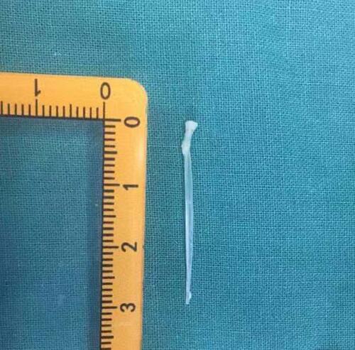 Figure 3 Photograph shows foreign body (fish bone) removed from patient’s esophagus.