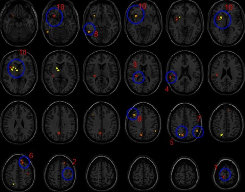 Figure 1 F-statistical maps showing ALFF differences among TRD, non-TRD and HCs.