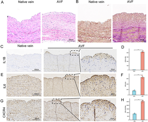 Figure 8 The result of immunohistochemistry staining showed that the expression of IL6, CXCR4 and IL1B were increased in AVFs. (A) The Hematoxylin and Eosin staining of native vein and AVF. (B) The Elastica van Gieson (EVG) staining of native vein and AVF. (C) The IHC result of IL1B in native veins and AVFs. (D) Box plot was used to show that the expression of IL1B significantly increased in AVF. (E) the IHC result of IL6 in native veins and AVFs. (F) Box plot was used to show that the expression of IL6 significantly increased in AVF. (G) the IHC result of CXCR4 in native veins and AVFs. (H) Box plot was used to show that the expression of CXCR4 significantly increased in AVF. Significant differences are indicated by ***P<0.001.