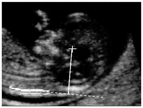 Figure 9. The distance between the center of the fetal head and the ‘NT’ plane.