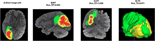 Figure 6. A) Brain image with tumour, B) Whole Tumor highlighted in green, C) Enhanced Tumor in yellow, D) Tumor Core in red, visualized using ITK-SNAP [Citation25] software tool used to view the brain tumour segmentation.