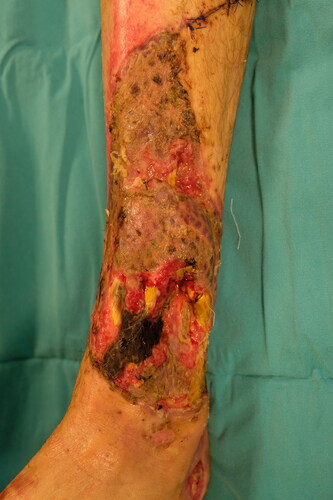 Figure 8. The patient sustained from high-voltage electric burns in his lower extremity and right hand. Although he had a muscle flap reconstruction and skin grafting previously, there was still anterior tibial muscle tendon and tibial bone exposure at the injured site.