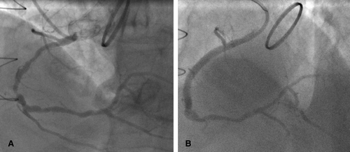 Figure 3.  (A) Severe diffuse disease in mid-RCA with anomalous origin from right sinus of Valsalva in LAO cranial projection. (B) Post-PCI of mid-RCA in LAO cranial projection.