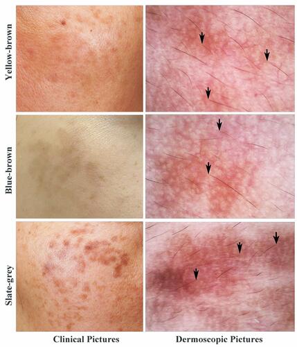 Figure 1 Clinical and dermoscopic images. Black arrows indicate involvement of pigment in hair follicles.