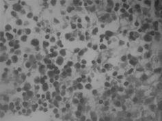 Figure 1. Plasma cell infiltration in bone marrow (H + E × 400).