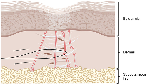 Figure 3 Wire subcision.