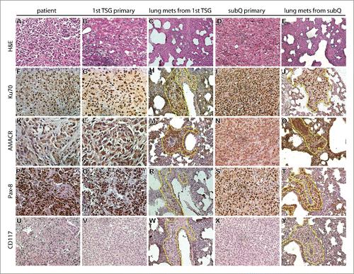 Figure 1. Histological and immunophenotype of parental (patient) tumor, its derived TSG and lung metastasis. (A-E) Hematoxylin and eosin (H&E) staining demonstrated similar histology among parental tumor, primary first generation (1st) TSG under the renal capsule and its derived lung metastasis, and primary subcutaneous (subQ) tumor from sixth generation TSG and its derived lung metastasis. IHC revealed similar expression of human-specific nuclear antigen Ku70 (F-J) and typical markers of pRCC including AMACR (K-O) and Pax-8 (P-T) among the parental tumor, primary TSGs and metastases. No expression of CD117 was detected (U-Y). Magnification of all images is 200×. Dotted lines in (H) (J) (M) (O) (R) (T) (W) and (Y) delineate metastatic tumor cells vs. mouse tissue in the lung.