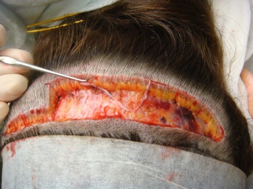 Figure 2 Photograph demonstrating the removal of the epidermal edge and creation of the ledge. Once the epidermal edge is removed, the wound is then sutured so that the superior edge slightly overlaps the inferior edge.