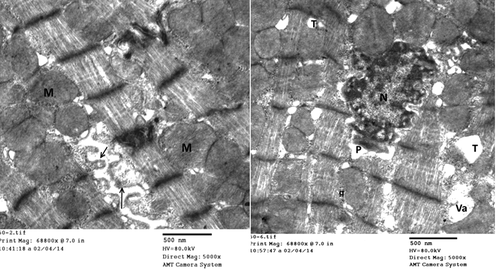 Figure 6. Electron micrographs of rat left ventricle (group III) showing, blebbing of sarcolemma (↑), irregular nucleus (n) with widening of perinuclear space (p), dilated T-tubules (t), vacuolation (Va) and swollen mitochondria (m). (Uranyl acetate/lead citrate stain).