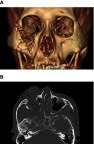 Figure 2 Preoperative facial bone CT (computed tomogaphy). (A) 3D imaged photo. (B) Transverse section of CT.