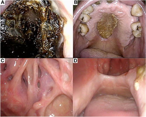 Figure 2 Endoscopic findings of progressive gangrene. (A) The destroyed nasal cavity was heavily crusted on admission. (B) Necrotic tissue on the oral palate at admission. (C) Sphenoid sinuses and (D) palate defect four months after additional necrotomy. Almost no necrotic tissue remained at either site.
