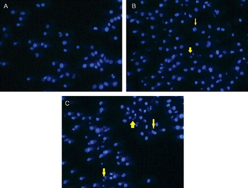 Figure 3. Fluorescence microscopy of MCF-7 cells treated with (A) vehicle, (DMSO; control), TAM (B) and TAM-loaded SLN (C). Cell shrinkage (thin arrow) and apoptotic cells are evident (thick arrow) (magnification ×40).