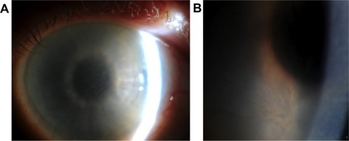 Figure 1 Clinical photographs of the right cornea.