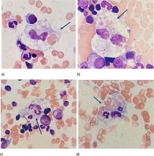 Figure 3 Figures description in order of appearance (a–d): Repeated bone marrow aspirate smears: The arrow points macrophages ingesting erythrocytes (a,b and d) and neutrophils (c and d), May Grunwald-Giemsa staining, ×1000.