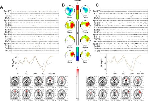 Figure 4 Individual examples of EEG trace (C), ERP, P300 response (B), absolute power (A), and bzLORETA maps (lower panels) of two patients with obsessive–compulsive disorder.