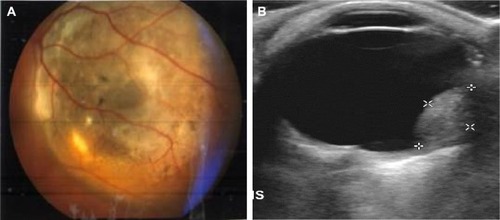 Figure 1 (A) Fundoscopy image of ocular melanoma; (B) measurements of height and maximum base diameter for choroidal melanoma on ultrasound scan.