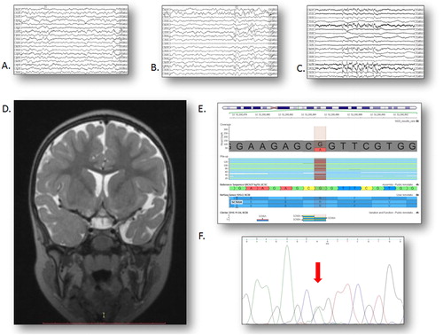 Figure 1. An overview of the neurological and molecular genetic status of the patient. (A) Interictal sleep EEG at 2 years, revealing sharp and slow waves predominantly in the left temporal leads (speed 15 mm/s). (B) Interictal sleep EEG at 3 years, revealing a generalised spike-wave discharge as well as frequent sharp and slow waves predominantly in the left anterior temporal leads (speed 15 mm/s). (C) Interictal sleep EEG at 5 years with a 5-second paroxysm of primary generalised slow spike-and-wave complexes predominant in the anterior leads (speed 15 mm/s). (D) Coronal T2 MRI scan at 3 years, revealing mild cortical atrophy with a more severe affection of the left temporal lobe. (E) NM_014191.3:c.5616G > A variant in exon 27 of the SCN8A gene in our patient; the replaced nucleotide is marked in red. (F) Sanger sequencing electropherogram of the same region.