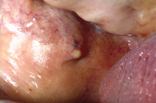 Figure 2. Acute bacterial sialadenitis: purulent discharge from the orifice of the parotid duct is seen when the gland is massaged. This figure was previously published in the book “Mondziekten, Kaak- en Aangezichtschirurgie, Handboek voor Mondziekten, Kaak-en Aangezichtschirurgie” by A. Vissink, F.K.L. Spijkervet and co-authors. 2023| ISBN 9789023258629. Copyright permission from the publisher Uitgeverij Van Gorcum B.V. was obtained.