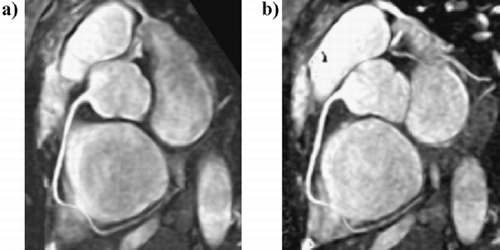 Figure 2. RCA images (MIP) derived from a healthy volunteer using parallel imaging. The breath‐hold time wasa 25 sec when using the 2 R–R interval approach (a) and 12 sec when applying the 1 R–R interval approach. Note the clear delineation of the distal segment of the RCA.