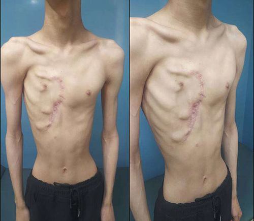 Figure 5 Patient’s appearance 6 months after operation.