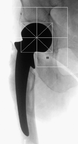 Figure 2. Regions of interest (ROI) in the periacetabulum using the De Lee and Charnley (Citation1976) zones.