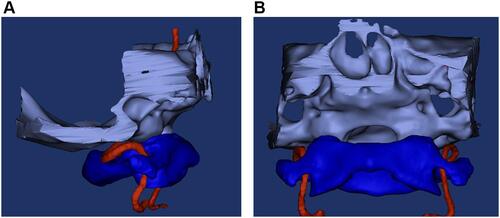 Figure 2 (A) Sagittal and (B) frontal views of 3D reconstruction model of skull base, atlas and vertebral artery.