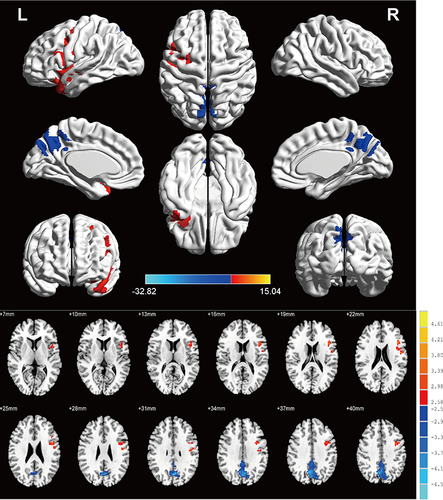 Figure 2 Brain regions with significantly different ReHo values in individuals with CRAO versus HCs. The color scale reflects the t values. Red indicates higher ReHo indices, and blue indicates low ReHo indices.