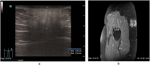 Figure 9 (a and b) A 21-year-old woman with pathologically proven lupus panniculitis on her right buttock. (a) Ultrasound shows the hyperechoic lesion with vague and ill-defined borders involving the subcutaneous fat, representing the inflammation of the fat. (b) T1-weighted fat-saturated gadolinium-enhanced MRI, sagittal view, shows the enhanced infiltrating lesion involving the skin and subcutaneous fat. The underlying muscle is preserved. MRI can delineate the deep margins of the lesion.