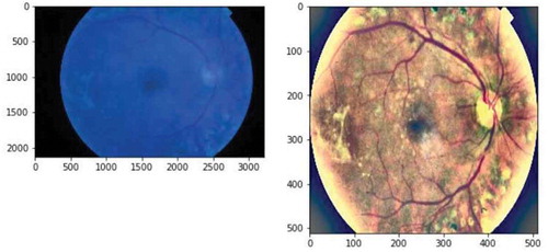 Figure 1. Examples of fundus images before(left) and after(right) preprocessing.