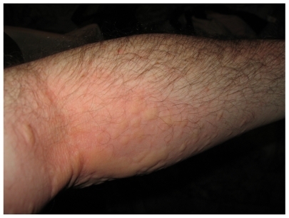 Figure 1 Appearance of contact exposure reaction in an allergic asthmatic patient to the larvae of the sycamore tussock moth, Halysidota harrisii Walsh, 1864. Inflammation and induration are evident in the anticubital fossa (site of catapillar exposure) with proximal and distal radiation.