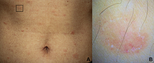 Figure 8 (A) Clinical image of pityriasis rosea, square indicates (B) dermoscopic image showing yellowish background with peripheral scales (x10 original magnification).