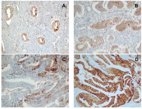 Figure 1 (A) Very mild ezrin expression in proliferative endometrial tissues. (B) Weak ezrin expression in cases of endometrial hyperplasia without atypia. (C) Moderate ezrin expression in patients with endometrial hyperplasia with atypia. (D) Severe ezrin expression in endometrial cancer cases.