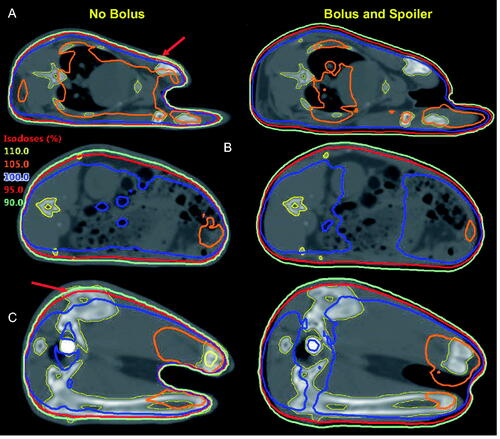 Figure 3. Isodose distributions in the absence (left) vs in the presence (right) of bolus and spoiler for an identical prescribed dose at mid-depth at the thorax (A), abdomen (B), and pelvis (C). Without bolus, the depth in which the dose reaches 95% is of the order of ∼0.6–0.7 cm. With bolus, the entire animal is covered by at least 90%, with 95% occurring within the first 0.1–0.2 cm below the surface. Of particular note, some of the bones (contoured in yellow) are not entirely covered by the 90% and 95% isodoses in the absence of bolus (see arrows).