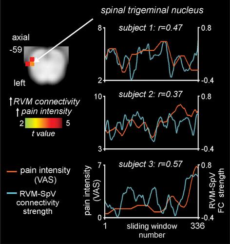 Figure 5 Brainstem region in which rostral ventromedial medulla (RVM) dynamic functional connectivity (FC) strength covaries significantly with ongoing pain in 10 fluctuating pain subjects. The overlay on the left shows the region of the spinal trigeminal nucleus (SpV) where RVM dynamic connectivity covaries positively (hot color scale) with pain measured on a visual analogue scale (VAS) from 0 = no pain to 10 = highest imaginable pain. Slice location in Montreal Neurological Institute space is shown at the top left of the axial slice. To the right are plots of pain intensity (orange line) and RVM-SpV connectivity strength (blue line) in three subjects. Note the ongoing relationship between changes in pain intensity and RVM-SpV connectivity strength.