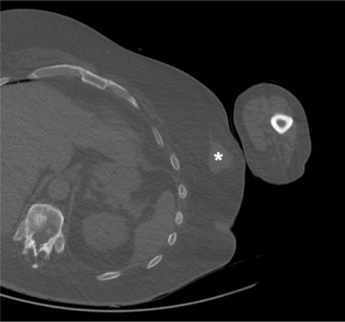 Figure 1 Axial cut of CT-chest demonstrates a well-circumscribed soft tissue density (*) in the left breast measuring 3.1×3.7 cm.